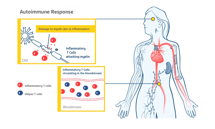 Autoimmune Response Diagram A diagram about the autoimmune response to multiple sclerosis.